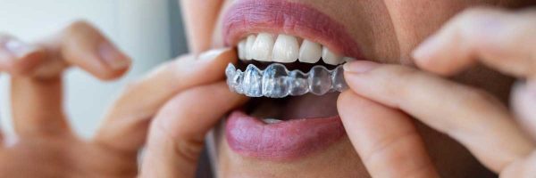 invisalign-cost-uk-how-much-is-invisalign-prices.jpg